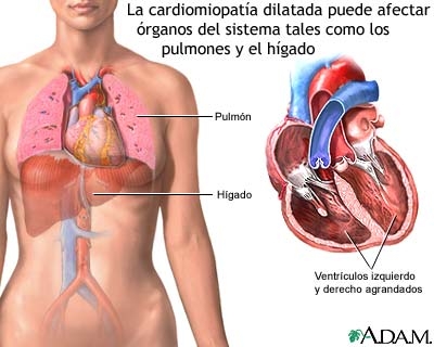 Cardiomiopatia primitiva